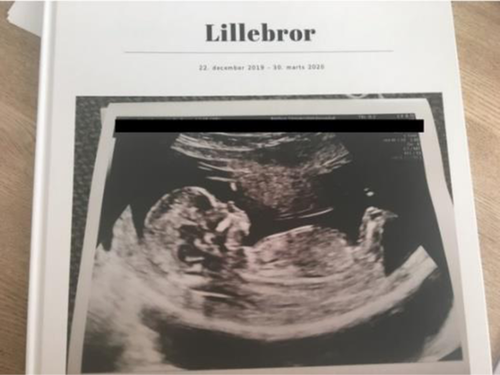 A book cover with the title Lillebror and an image of a fetal ultrasound. 